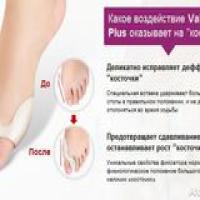 Altus Pro - средство от косточки
